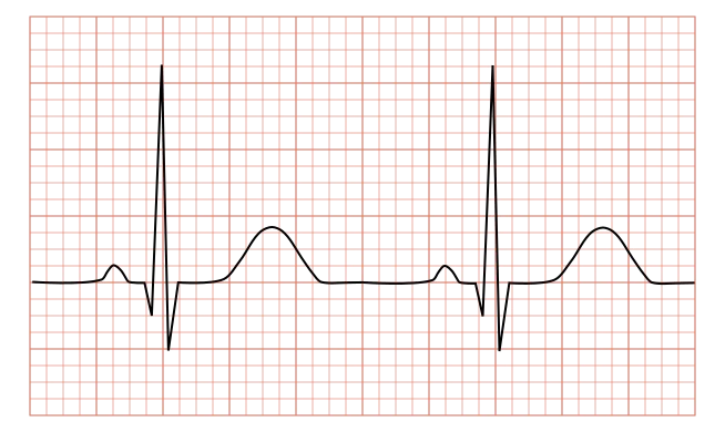 EKG